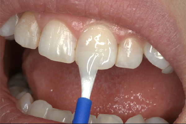 Fluoride
